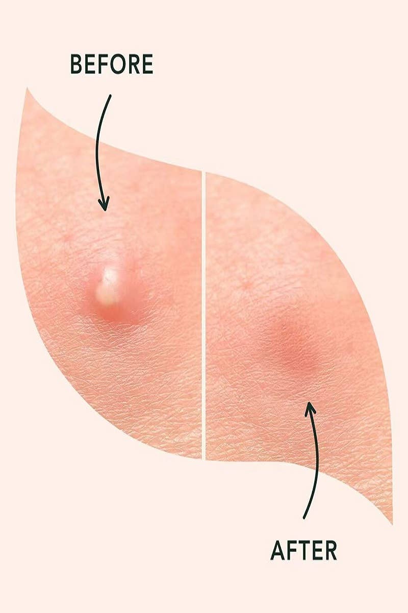 ,....1028 The Original Hydrocolloid Acne Pimple Patch  SI-27832