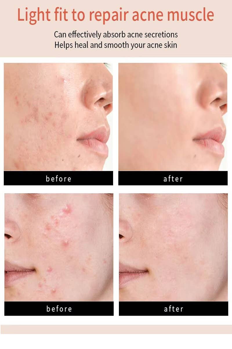 ,....1028 The Original Hydrocolloid Acne Pimple Patch  SI-27832