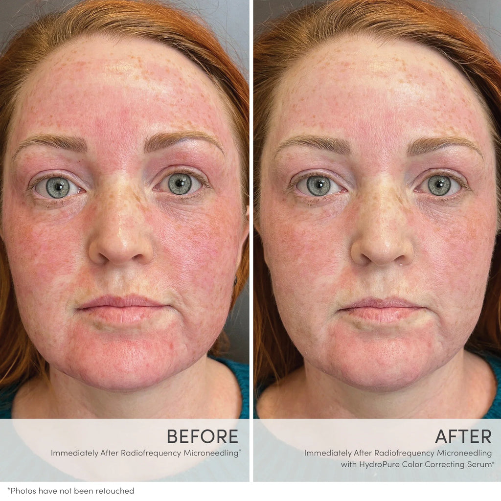 HydroPure™ Color Correcting Serum with Hyaluronic Acid & CoQ10